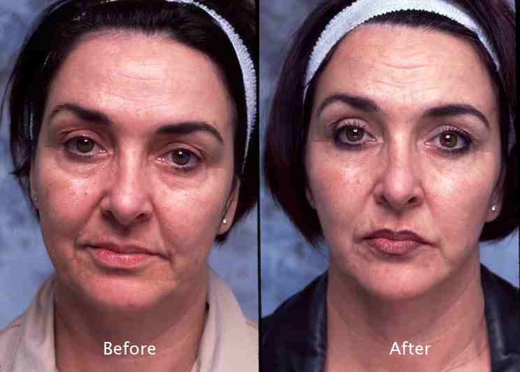 face and neck liposuction Beverly Hills