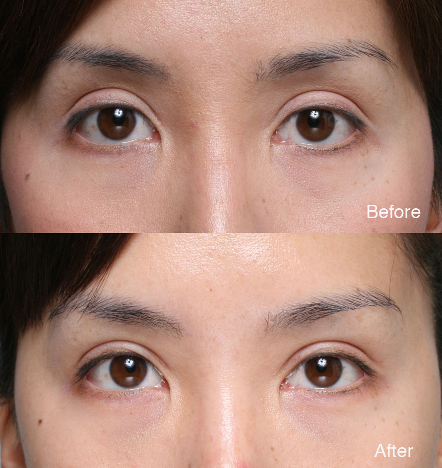 Asian Eyelid Surgery Photos 4