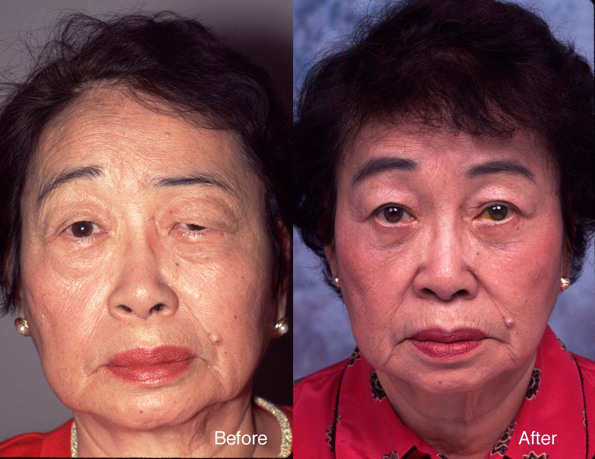beverly hills asian eyelid surgery