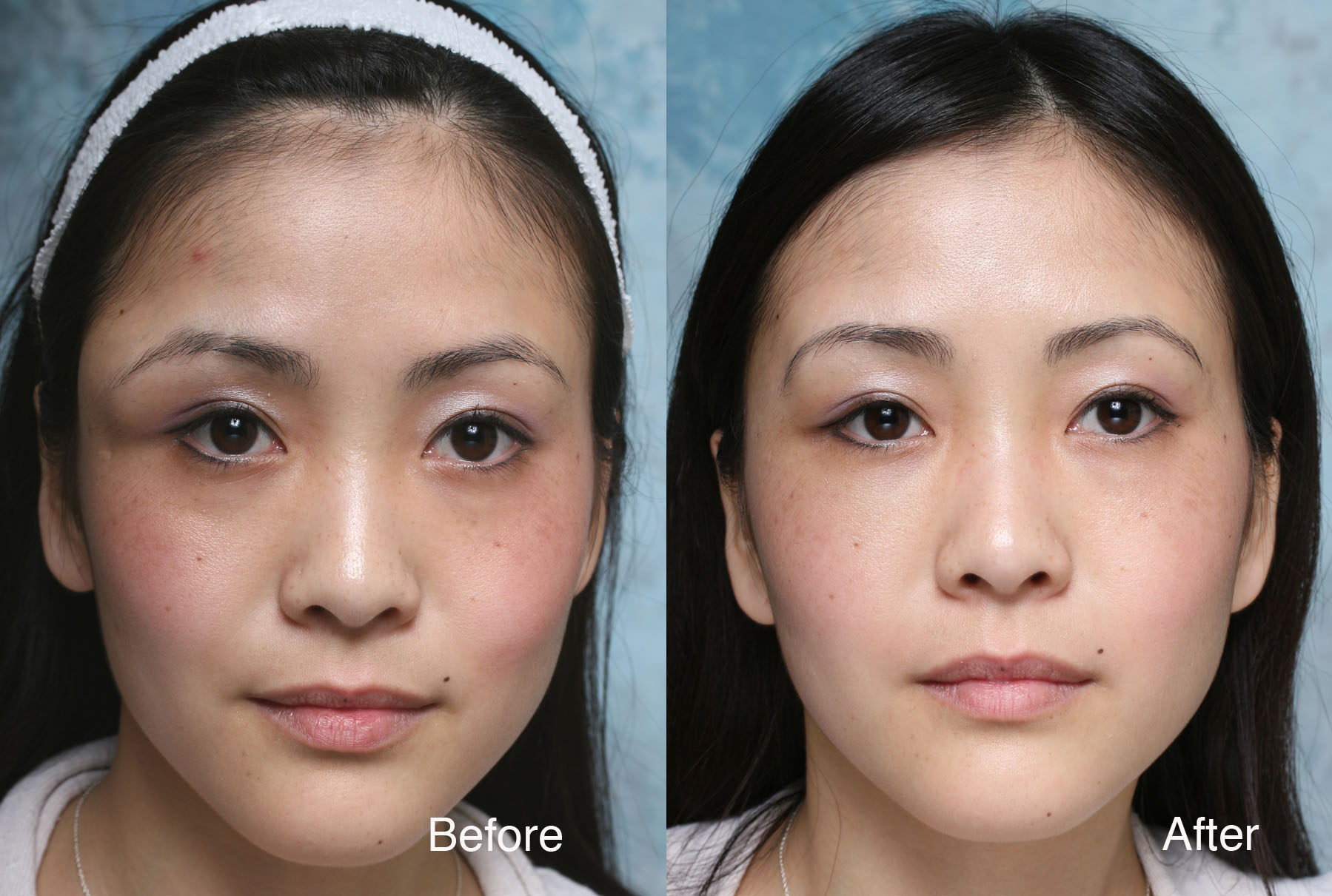 Asian Eyelid Surgery Photos 112