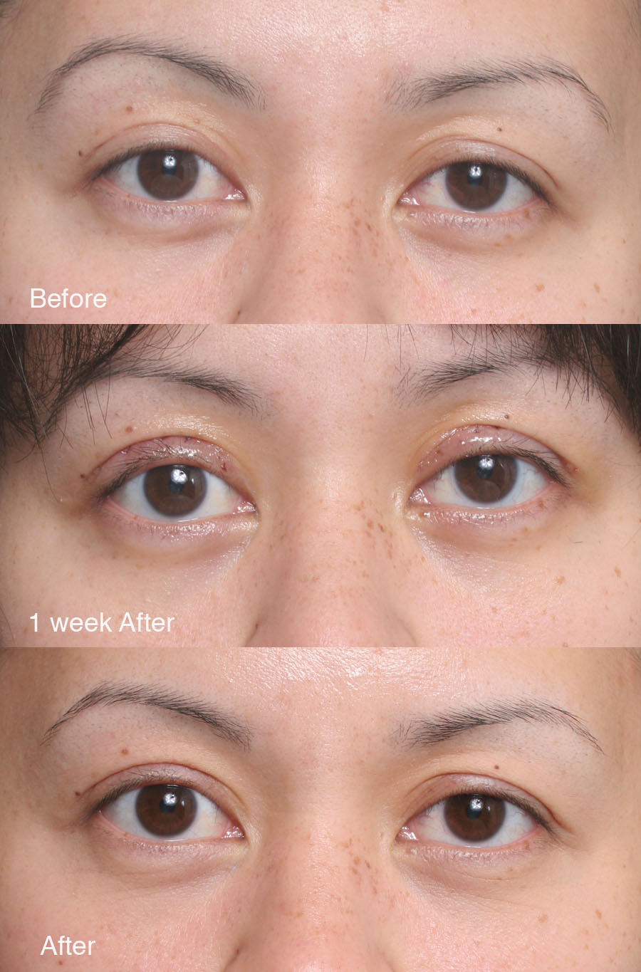 Asian Eyelids Surgery 68