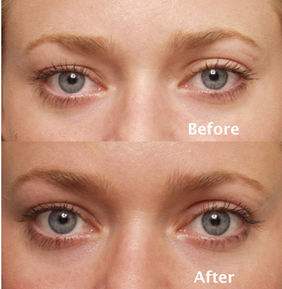 Eyelid Case Studies | Eyelid Ptosis Surgery | Beverly Hills | Los Angeles