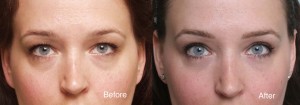 Eyelid surgery example 