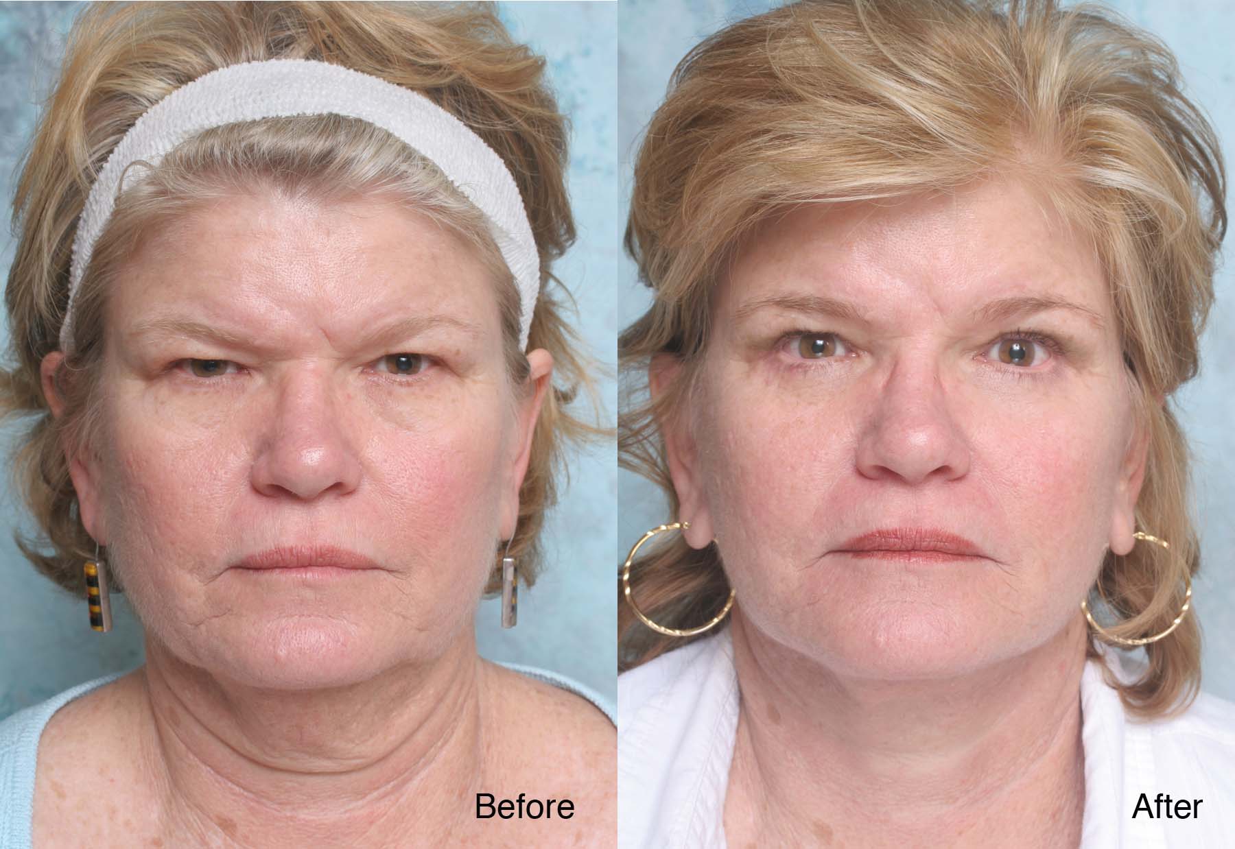 Facial-surgery-example-10-L