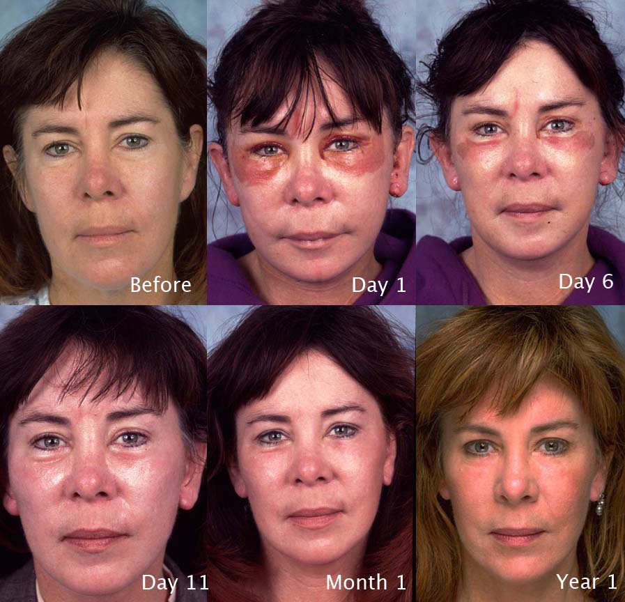Facial-surgery-example-6a-L