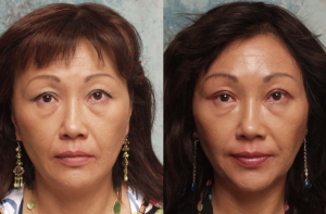 Asian Blepharoplasty | Eyelid Surgery | Beverly Hills | Los Angeles CA