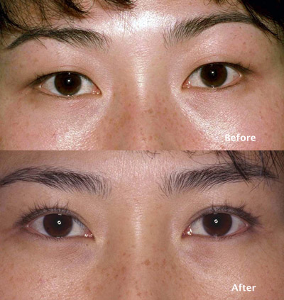 beverly hills asian eyelid surgery