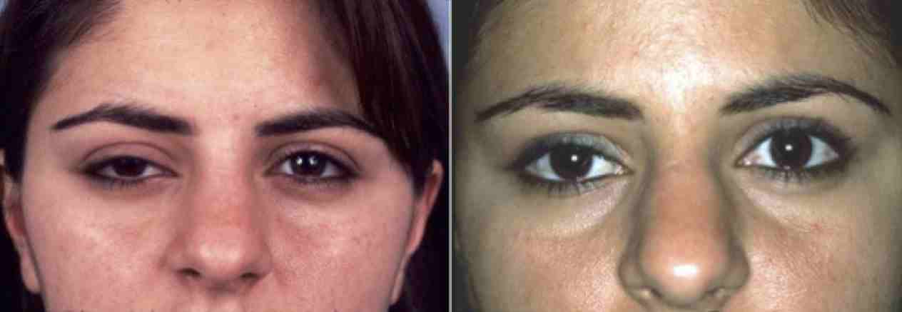 eyelid malposition surgery before and after