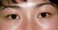 Asian Eyelid Surgery