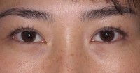 Eyelid Surgery