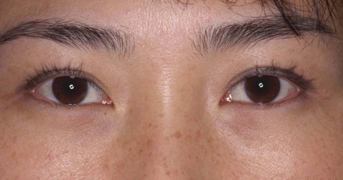 Asian Eyelid Surgery