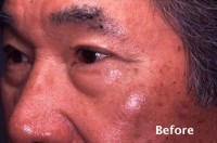 Asian Eyelid Surgery