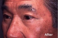 Eyelid Surgery