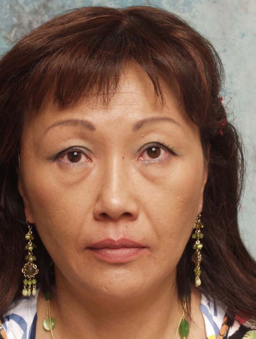 Asian Eyelid Surgery