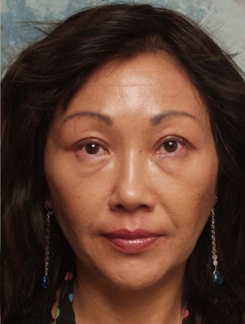 Asian Eyelid Surgery