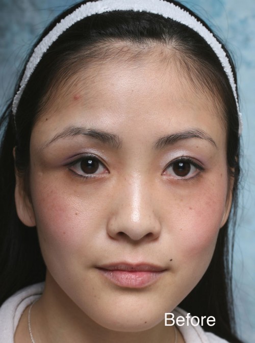 Asian Eyelid Surgery