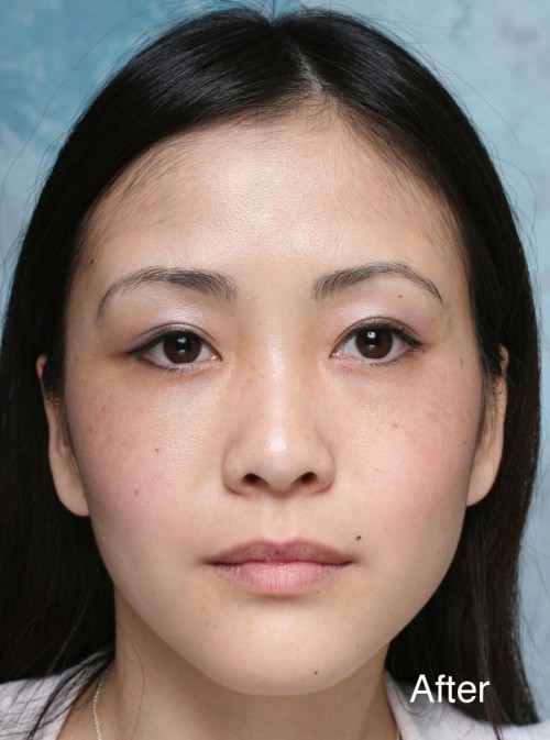 Asian Eyelid Surgery