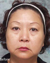 Asian Eyelid Surgery