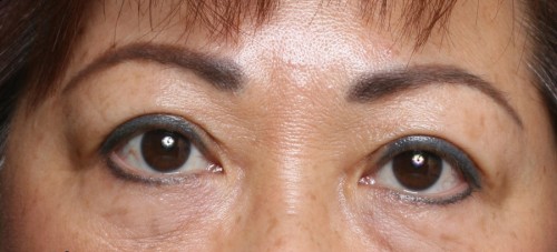 Asian Eyelid Surgery