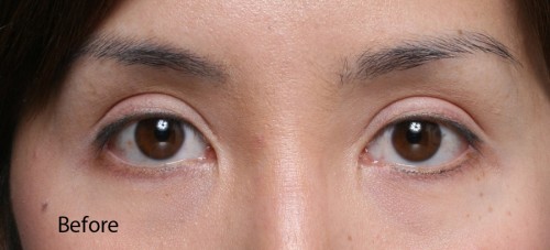 Asian Eyelid Surgery