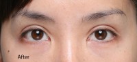 Asian Eyelid Surgery