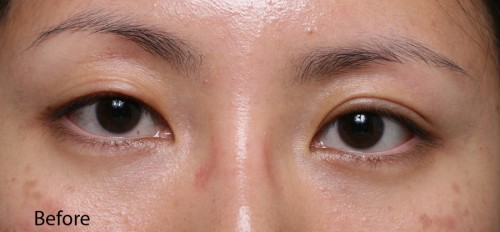 Asian Eyelid Surgery