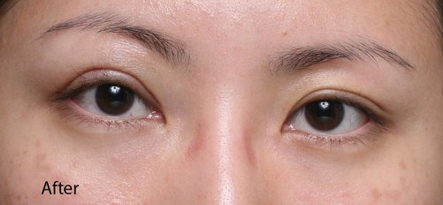 Asian Eyelid Surgery