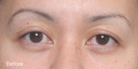 Asian Eyelid Surgery