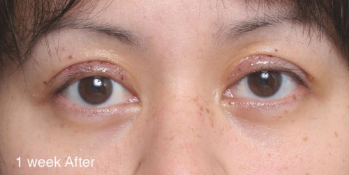 Asian Eyelid Surgery