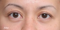 Asian Eyelid Surgery