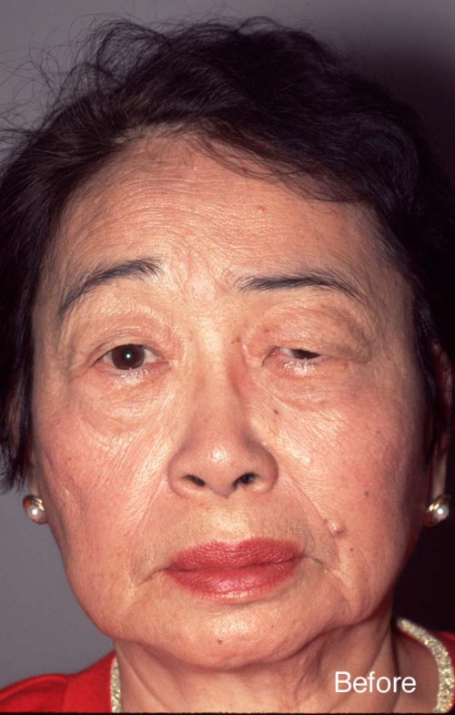 Asian Eyelid Surgery