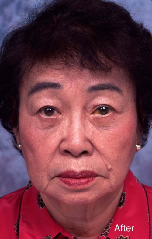 Asian Eyelid Surgery