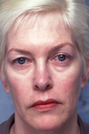 Eyelid Surgery