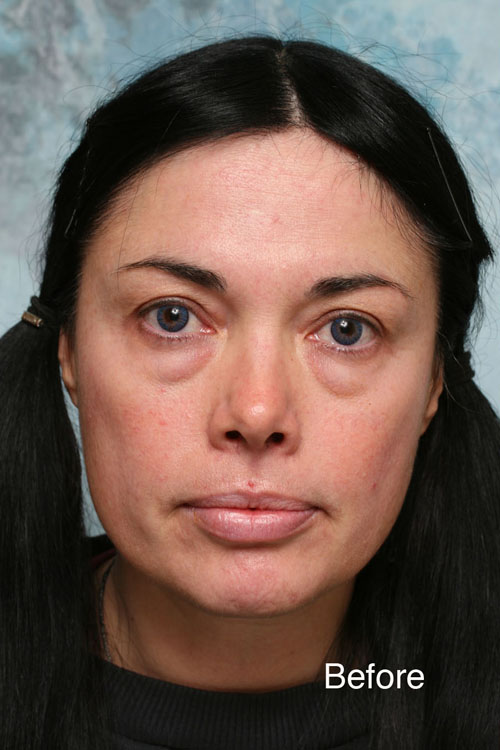 Eyelid Surgery