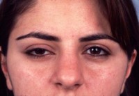 Eyelid Surgery