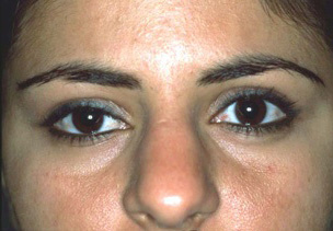 Eyelid Surgery