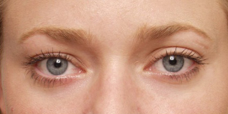 Eyelid Surgery