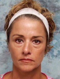 Eyelid Surgery