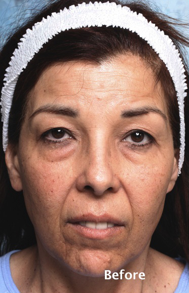 Eyelid Surgery