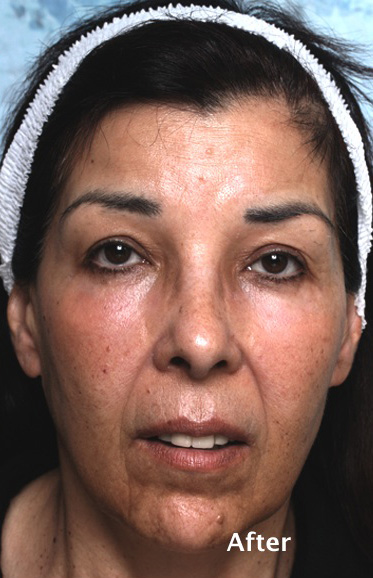 Eyelid Surgery