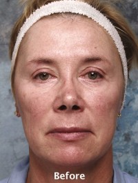 Facial Rejuvenation