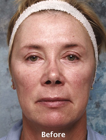 Face Liposuction
