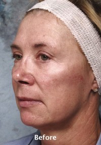 Face Liposuction