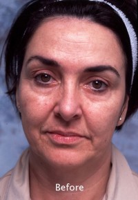 Face Liposuction