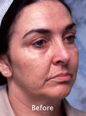 Face Liposuction