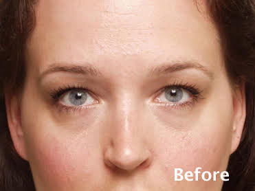 Eyelid Surgery