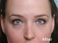 Eyelid Surgery