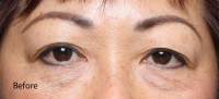 Asian Eyelid Surgery