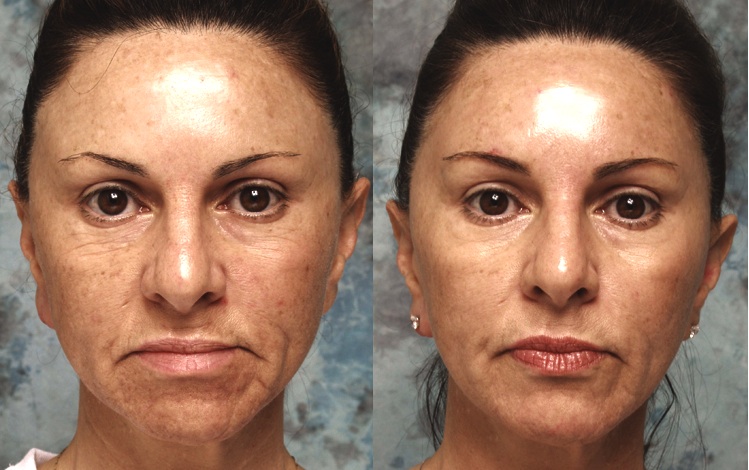 Los Angeles Crows Feet Treatment Best Patient Info.