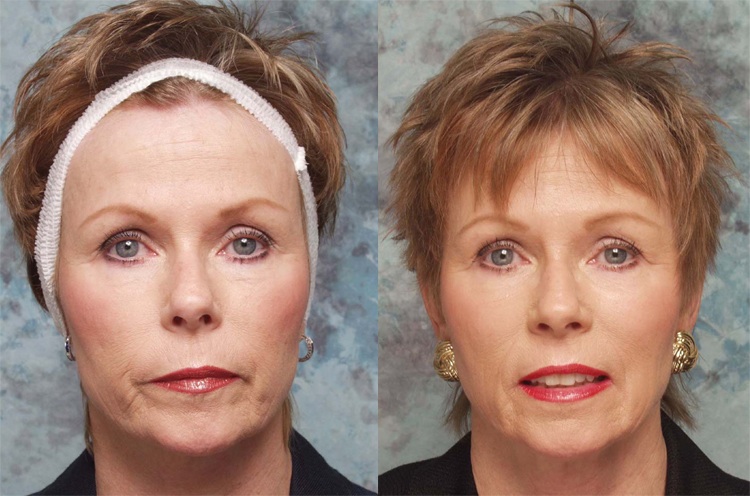 checmical peel beverly hills before and after